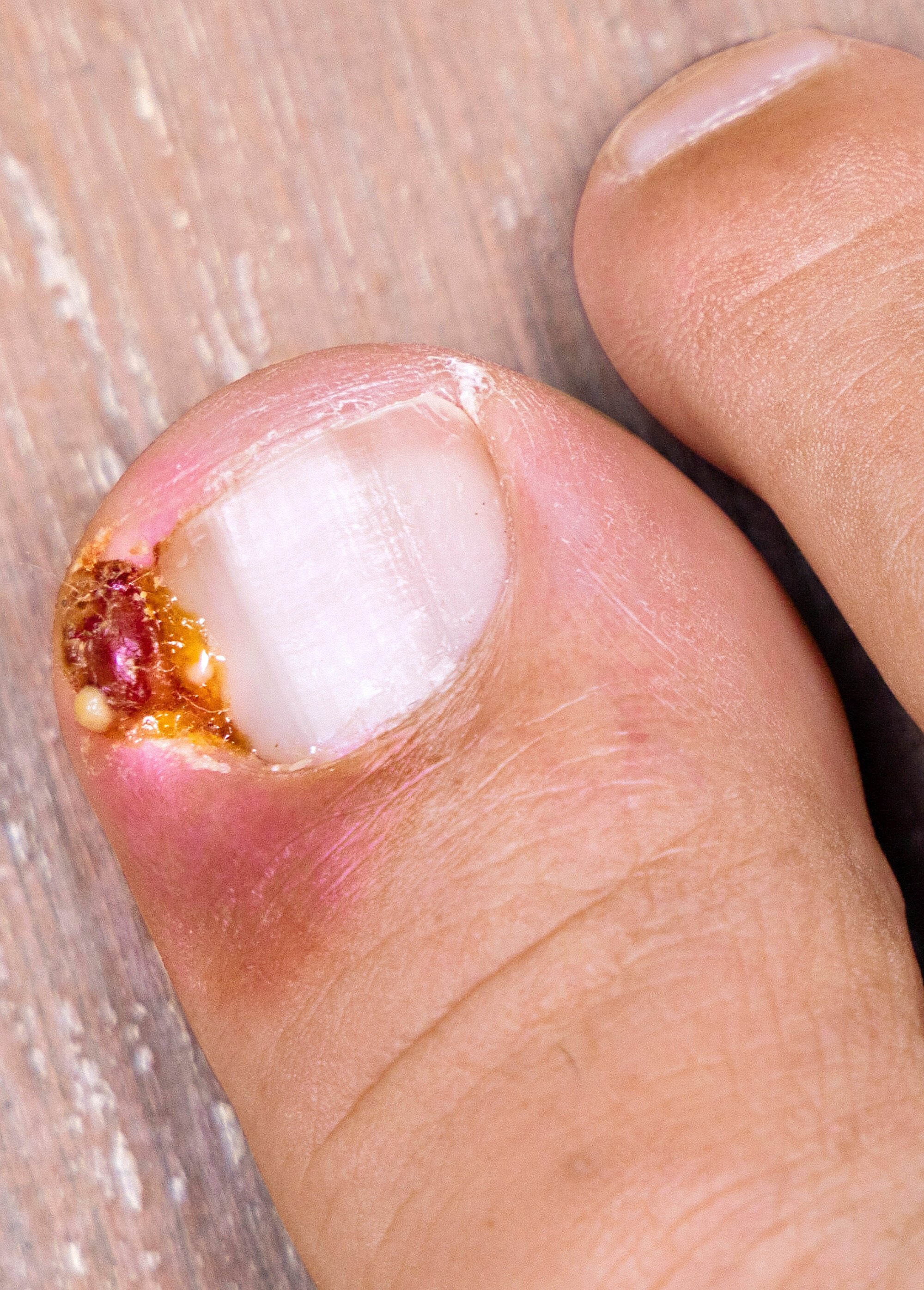 Treatment_of_ingrown_nails_and_onyxis_Onyxis_tincture_DE1_slim